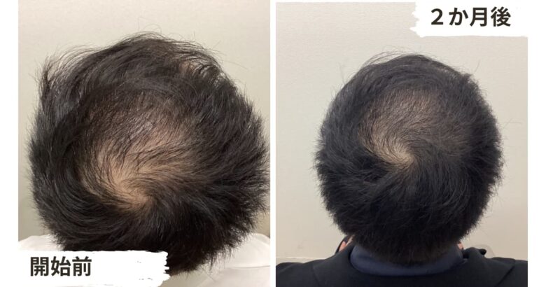 薄毛対策の低出力レーザーAGA治療2か月目の結果１