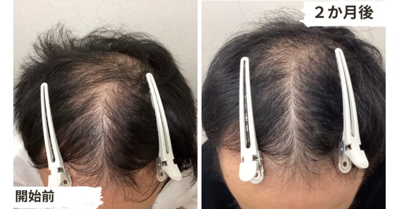 薄毛対策の低出力レーザーAGA治療2か月目の結果２