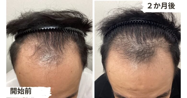 薄毛対策の低出力レーザーAGA治療2か月目の結果3