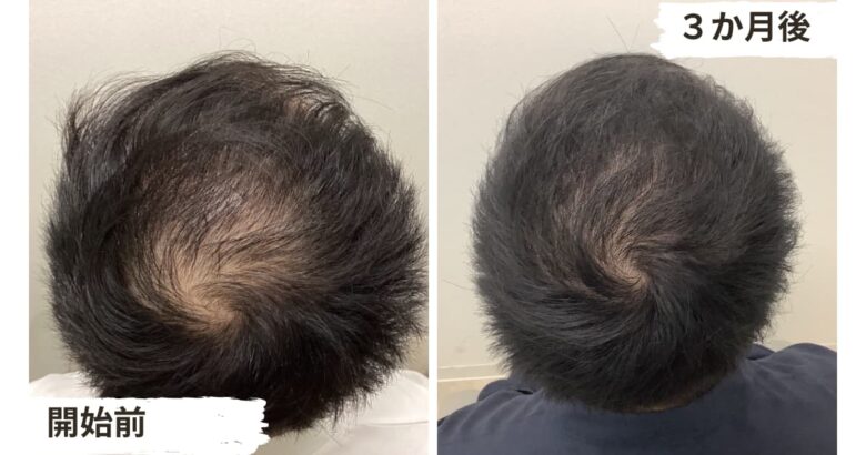 【3ヶ月リアル体験談】低出力レーザー治療の育毛効果とは1