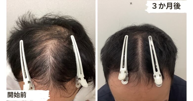 【3ヶ月リアル体験談】低出力レーザー治療の育毛効果とは2