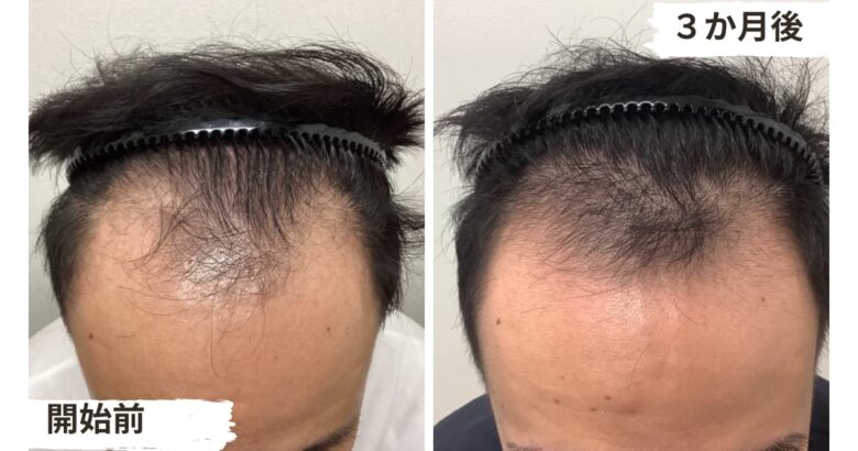 【3ヶ月リアル体験談】低出力レーザー治療の育毛効果とは3