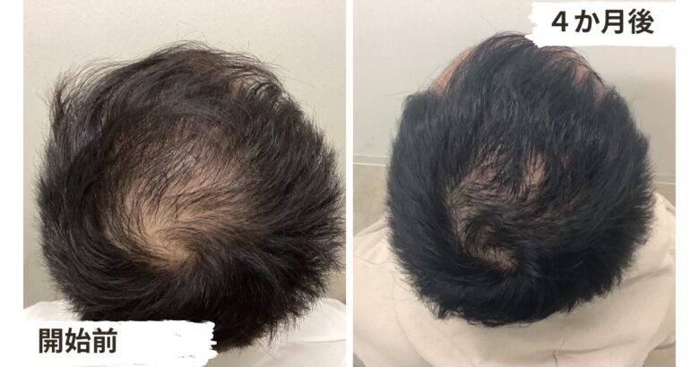 【4か月目】低出力レーザー育毛器を使った薄毛治療の効果1